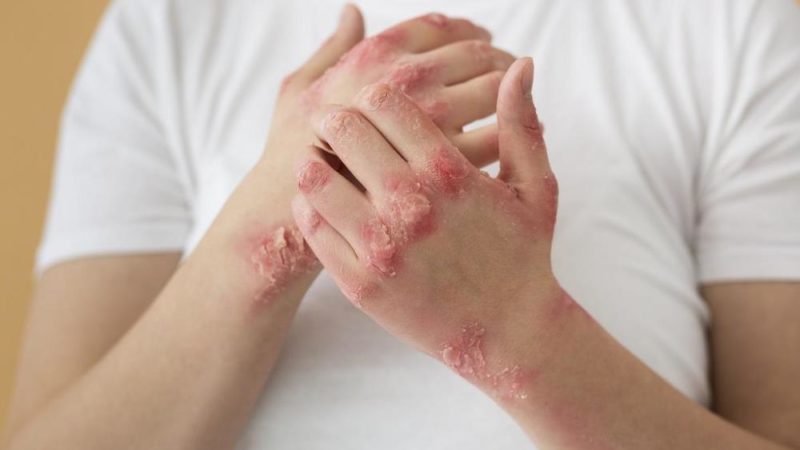 Campaña de detección gratuita de enfermedad psoriásica